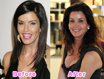 Plastic Surgery Disasters on Http   Topick Jp Wp Content Uploads Plastic Surgery Disasters 7 Jpg